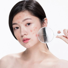 Mụn và cách điều trị mụn hiệu quả tại nhà
