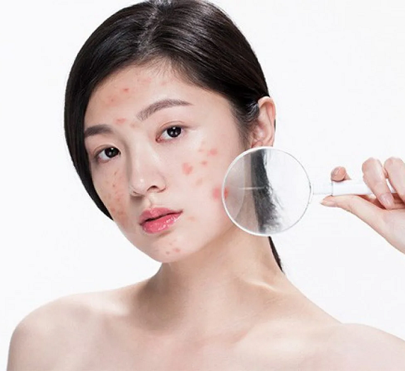 Mụn và cách điều trị mụn hiệu quả tại nhà