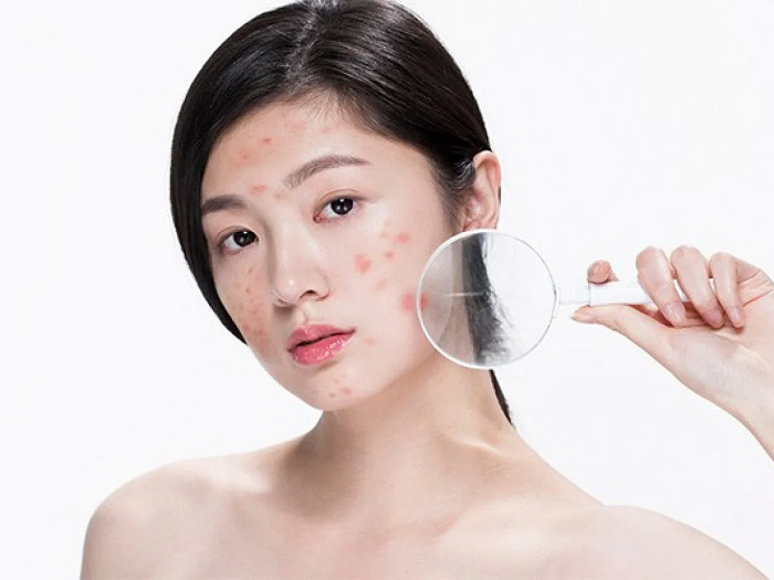 Mụn và cách điều trị mụn hiệu quả tại nhà